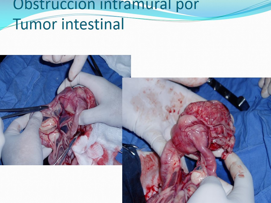 Obstrucción intestinal